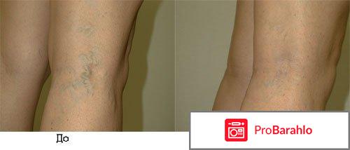 Этоксисклерол обман