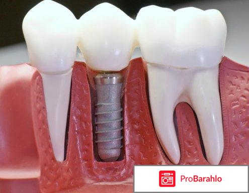 Имплантация зуба 