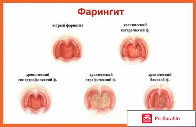 Лечение хронического фарингита 