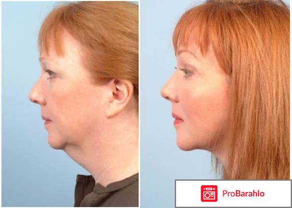 Липолитики для подбородка обман