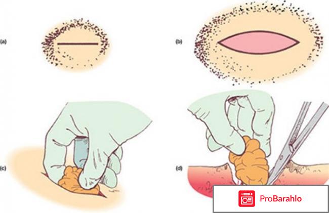 Атерома лечение в домашних условиях отзывы отрицательные отзывы