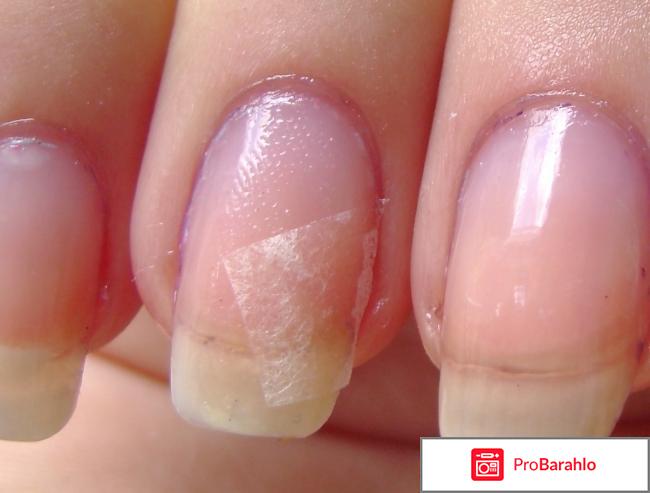 Что делать если сломался ноготь 