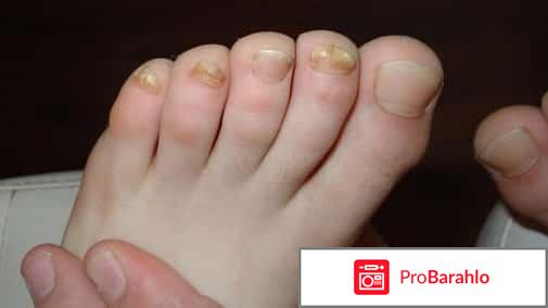 Грибок ногтей лечение препараты недорогие но эффективные отрицательные отзывы