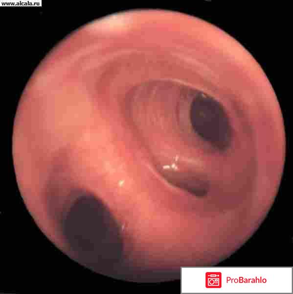 Бронхоскопия отзывы пациентов отрицательные отзывы