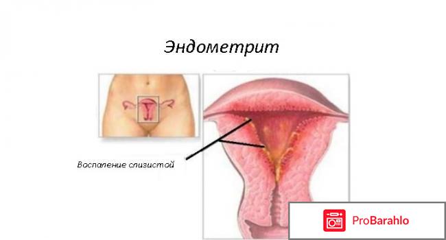 Эндометрит у женщин: виды, симптомы, лечение 