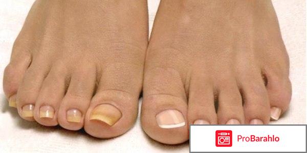 Экзодерил раствор отзывы отрицательные отзывы