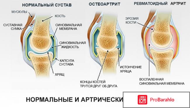 Пантофлекс (Pantofleks) обман