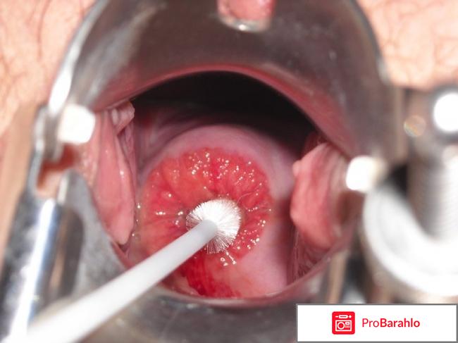 Лечение эррозии народными средствами отрицательные отзывы