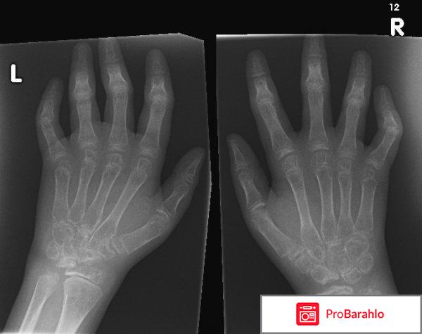 Артроцельс цена отрицательные отзывы