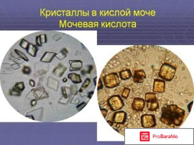 Чем опасна мочевая кислота в организме человека 