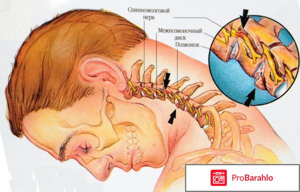 Хрустит шея что делать реальный отзыв 