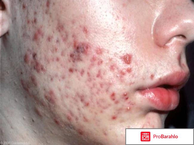 Андрогенное акне отрицательные отзывы