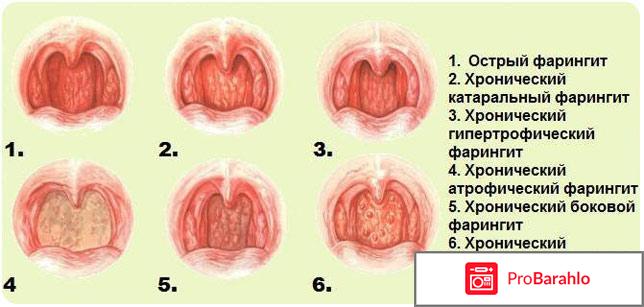 У ребенка красное горло 