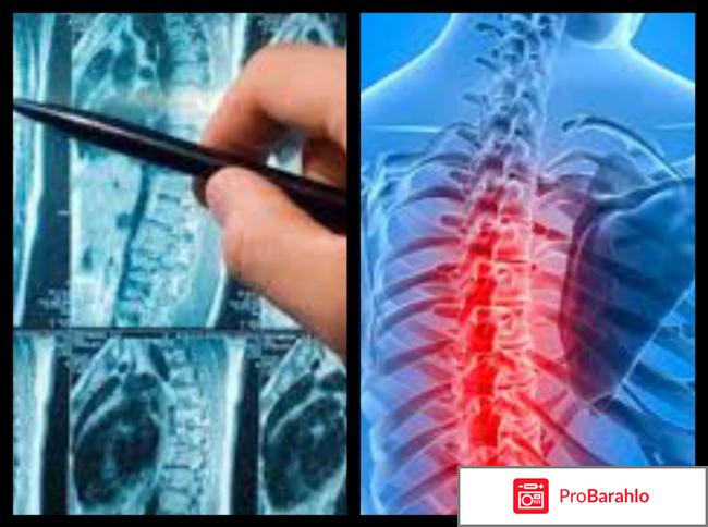 Мрт грудного отдела позвоночника что показывает 