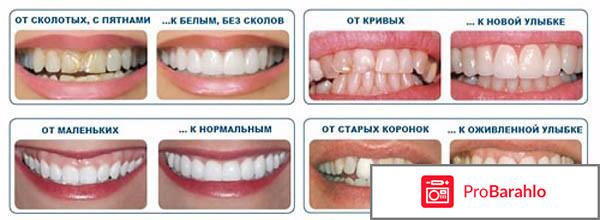 Виниры отзывы отрицательные 