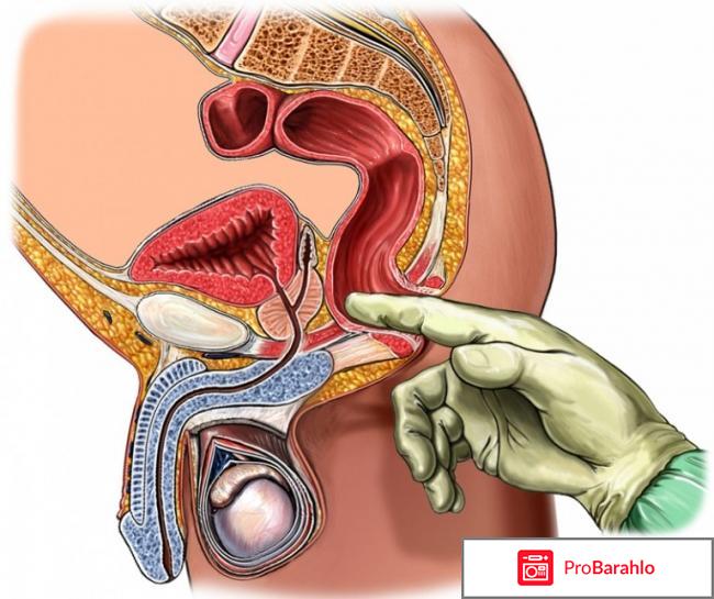 Лечение простатита народными средствами в домашних условиях отрицательные отзывы