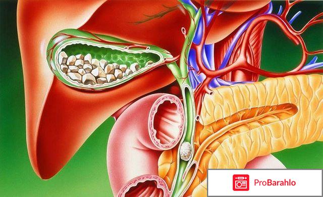 Урсосан отзывы врачей и побочные эффекты отрицательные отзывы