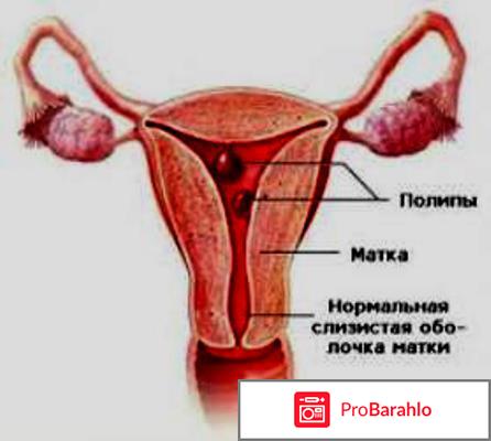 Признаки полипа в матке 