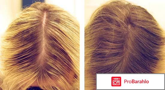 Мезотерапия волос отзывы фото до и после обман