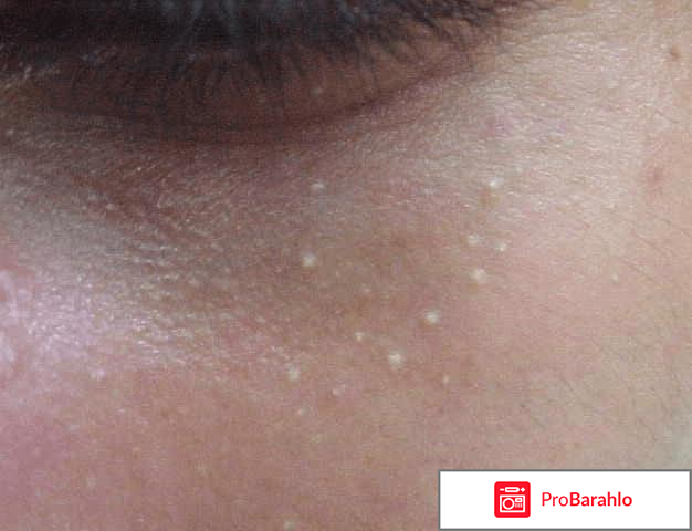 Жировики под глазами: почему они возникают обман