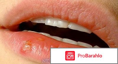 Ацикловир инструкция по применению реальные отзывы