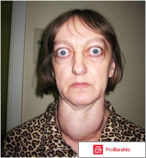 Противопоказания при гипертиреозе 