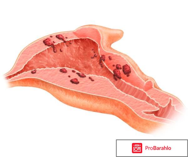 Обильные выделения реальные отзывы