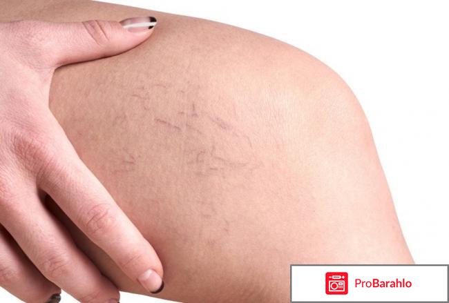 Венотонизирующие препараты обман