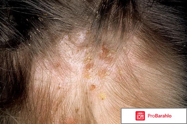 Болячки на голове 