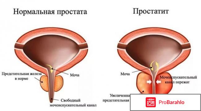 Простаплант инструкция по применению цена реальные отзывы