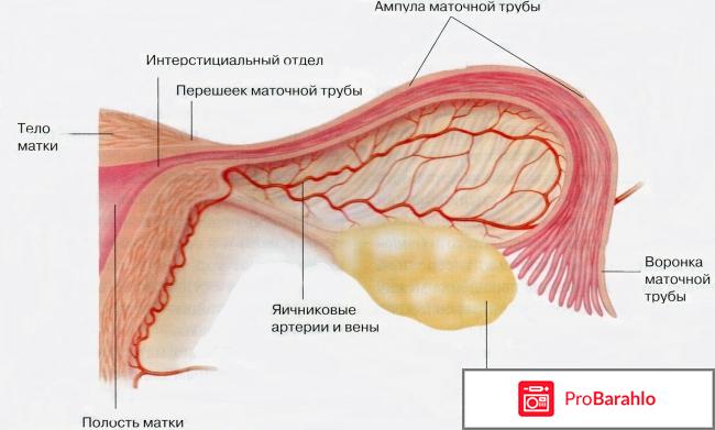 Сальпингит 