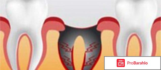 Уход после удаления зуба 