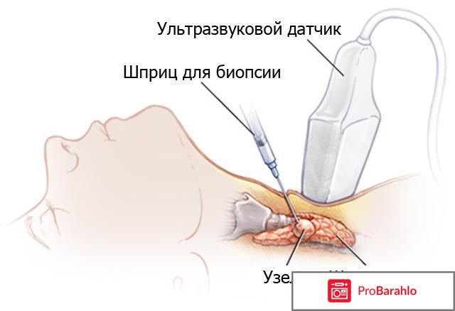 Биопсия щитовидной железы 