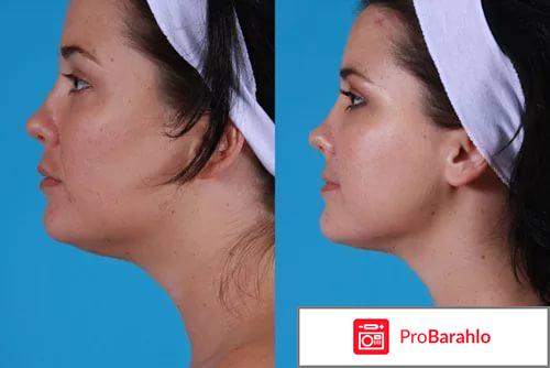 Липолитики для подбородка отзывы 