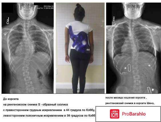 Корсет шено отрицательные отзывы отрицательные отзывы