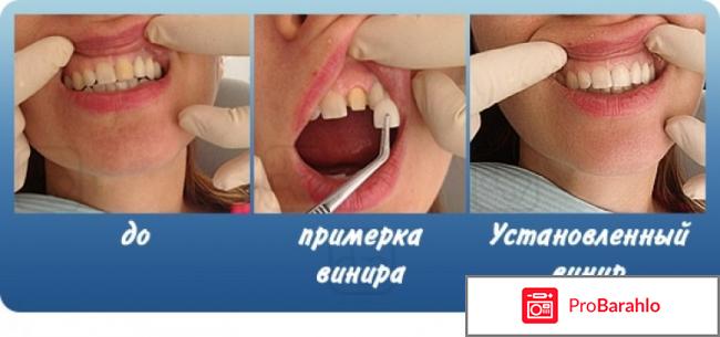 Виниры отзывы отрицательные отрицательные отзывы