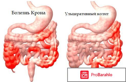 Колит отрицательные отзывы