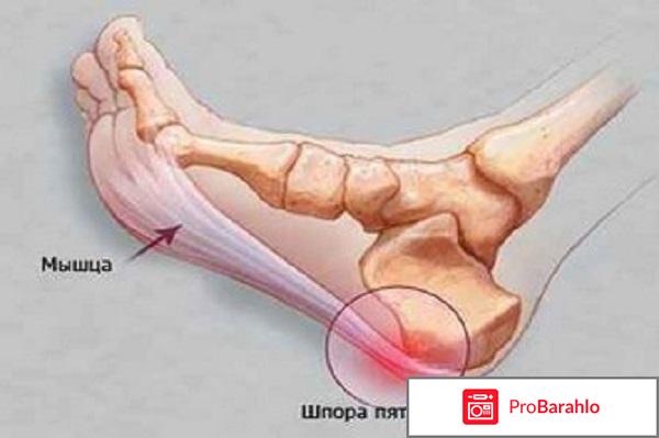 Мазь пяткошпор обман