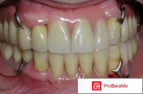 Бюгельное протезирование 