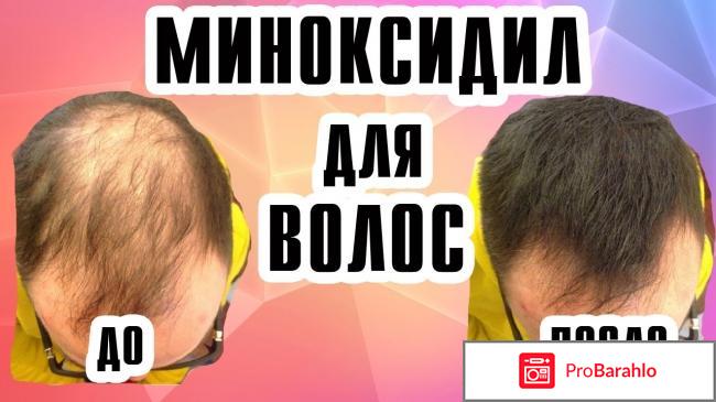Миноксидил для волос отзывы женщин обман