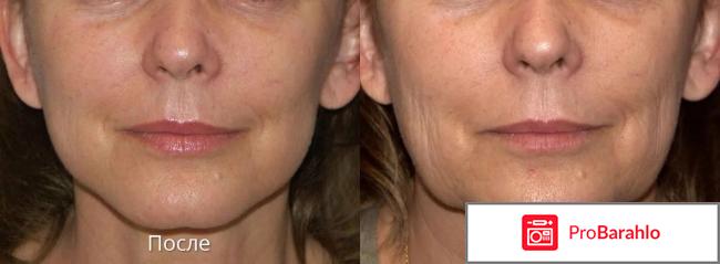 Липолитики для подбородка фото