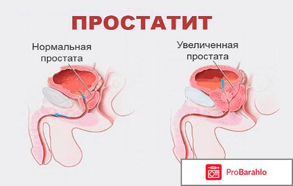 Цернилтон отзывы мужчин отрицательные отзывы