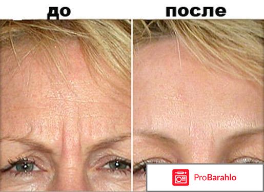 Диспорт фото до и после фото