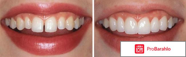 Виниры на зубы фото отзывы 
