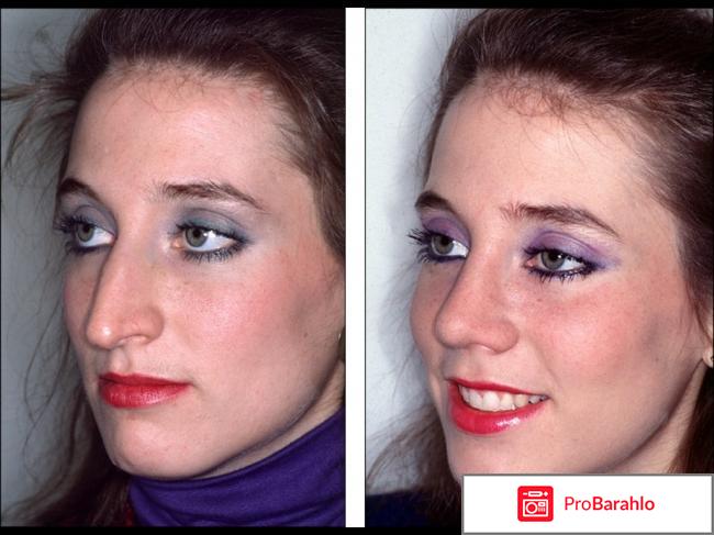 Ринопластика носа отрицательные отзывы