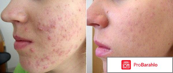 Ихтиоловая мазь от прыщей: польза, противопоказания отрицательные отзывы