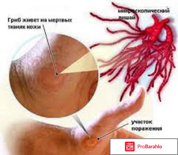 Розовый лишай у детей: симптомы и лечение отрицательные отзывы