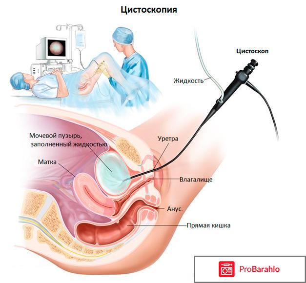 Цистоскопия мочевого пузыря у женщин фото