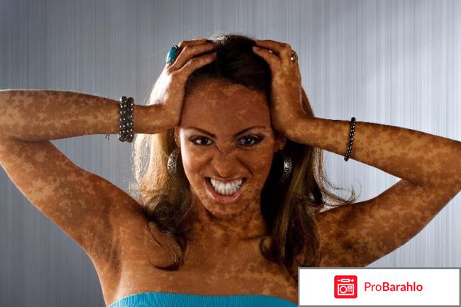 Кто-нибудь излечился от витилиго 