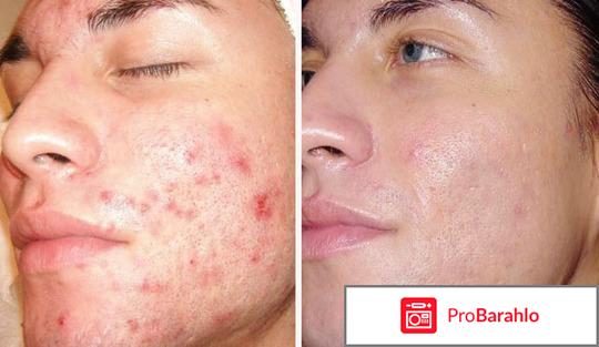 Дермабразия отзывы отрицательные отзывы